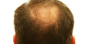 Haarverpflanzung – dichtes Haar für jeden