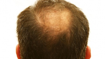 Haarverpflanzung – dichtes Haar für jeden