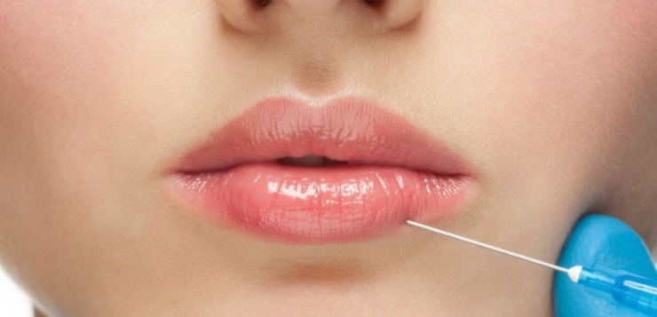 Lippen aufspritzen lassen – volle Lippen für ein strahlendes Lächeln