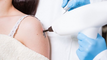 Tattoos entfernen mit dem Laser – eine schonende Methode