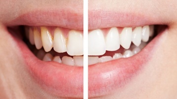 Zahnbleaching – in 6 Schritten zum strahlenden Lächeln