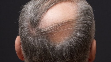 Keine Angst vor der Haarimplantation