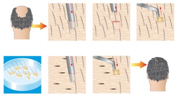 Ein Leben mit Haarimplantat