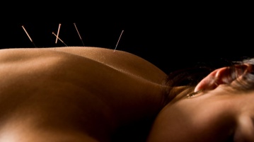 Akupunktur – Eine alternative Therapie