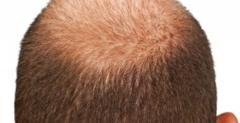 Haartransplantation– die wichtigsten Infos rund um den Eingriff